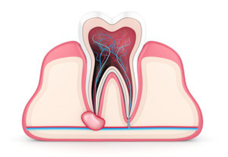Endodoncia en Madrid