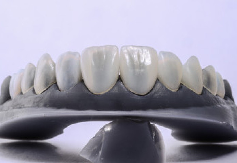 Implantes dentales